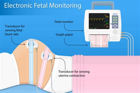 fetal monitoring game|Iba pa.
